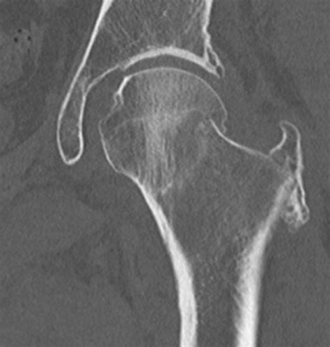 Subcapital Femoral Neck Fracture