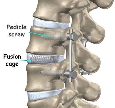 Lumbar Fusion Surgery London, UK | Spondylosis London UK