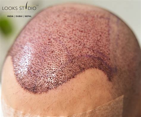 Hair Transplant Candidates Archives - Hair Transplant | Looksstudio | Blog