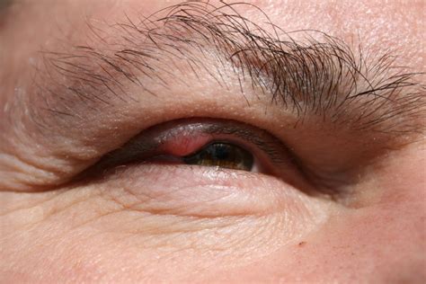 Eyelid inflammation (blepharitis) causes, symptoms, and treatment