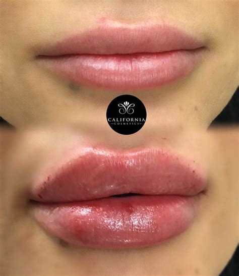 See this Instagram photo by @california_cosmetics • 4,191 likes | Botox lips, Lip fillers, Lip ...