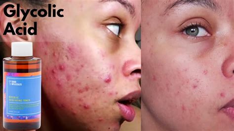 GLYCOLIC ACID - GOOD MOLECULES - ACNE PRONE SKIN - SKIN OF COLOUR - YouTube