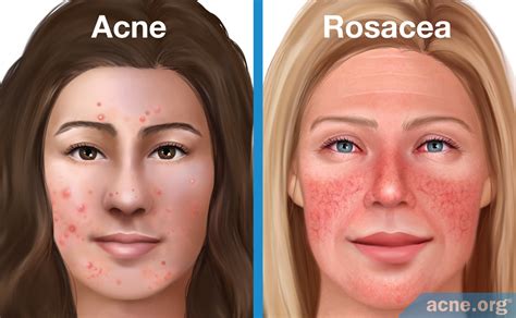 Rosacea Acne