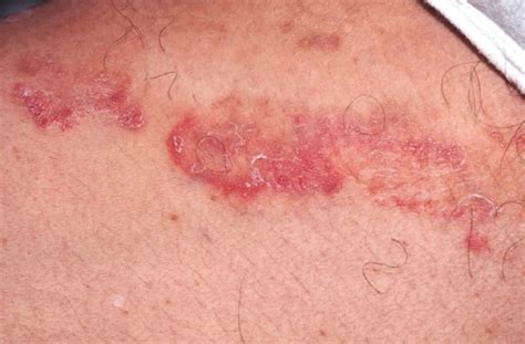 Tinea cruris definition, causes, symptoms & over the counter treatment