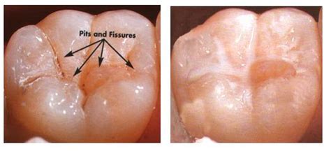 Pit And Fissure Sealants