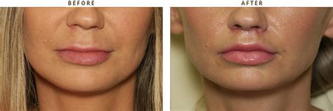 Lip Reshaping Before And After | Sitelip.org