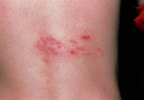 Rash Of Shingles (herpes Zoster) On Lower Back Photograph by Dr P. Marazzi/science Photo Library