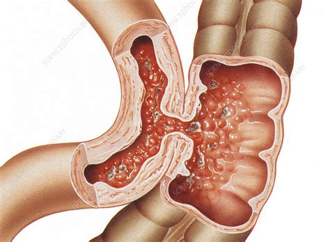 perecer analizar Variedad colo colonic fistula vídeo Días laborables lavanda