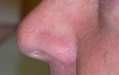 Basal Cell Carcinoma Cancer on My Nose - Mohs Surgery: Basal Cell Carcinoma Cancer on My Nose ...