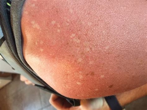 Why Is My Skin Spotty After Being In The Sun | Heidi Salon
