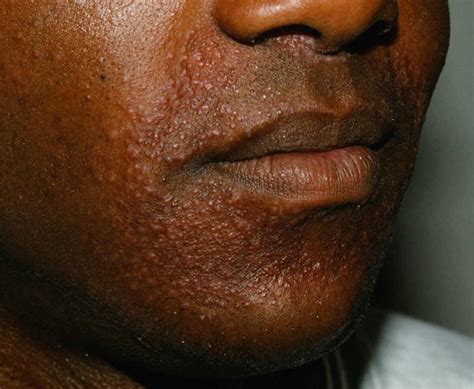 Childhood granulomatous periorificial dermatitis syn. facial Afro-Caribbean childhood eruption ...