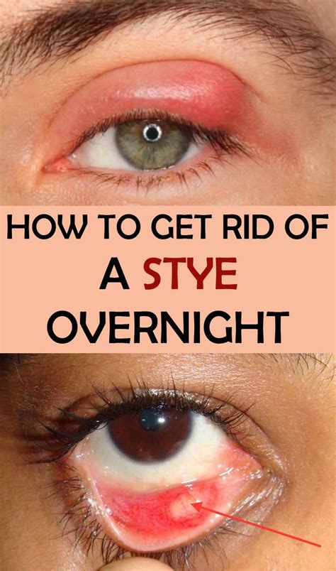 How To Get Rid Of a Stye Overnight - Beauty-TipsZone.com | Eye stye ...