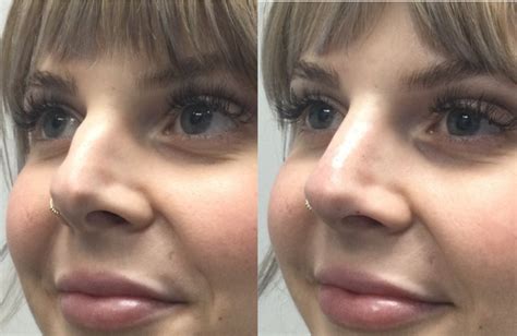 Nose Filler Appointments near Raleigh-Durham| Radiance Rx