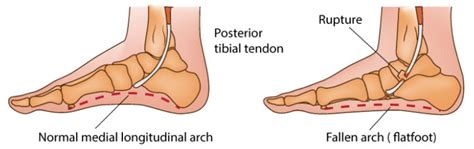 Flat Feet Pain Relief Reconstruction Surgery Melbourne | Mr Goldbloom