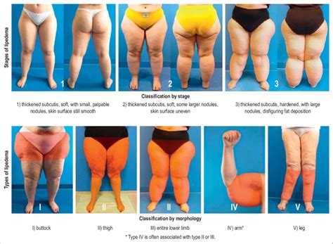 Learn About Stages And Types Of Lipedema | edu.svet.gob.gt