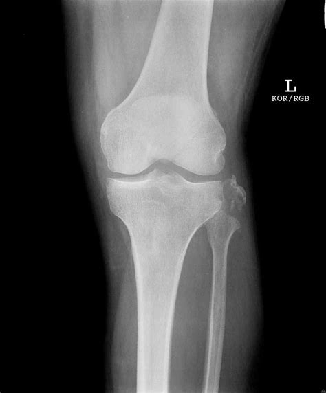 Fibula Fractures Article