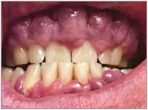 Oral Kaposi Sarcoma - Enlargement of the upper and lower attached and ...