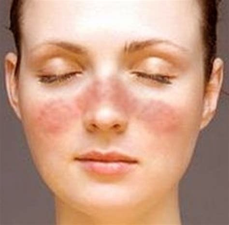 Rash on Face - Treatment, Causes, Pictures | HubPages