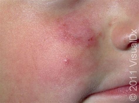 Ringworm, Facial (Tinea Faciei) Condition, Treatments and Pictures for ...