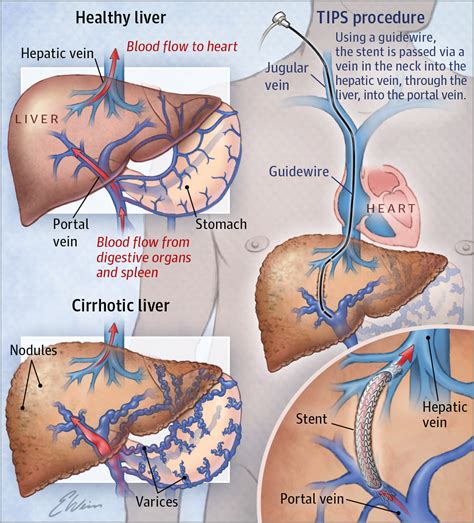 Transjugular Intrahepatic Portosystemic Shunts JAMA. 2017;317(8):880 ...