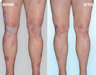 Psoriasis Before & After Pictures | SKYRIZI® (risankizumab‐rzaa)