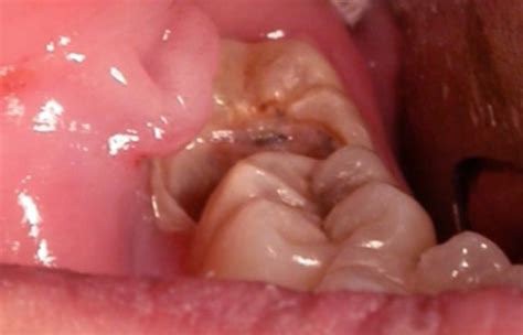 Wisdom Tooth Infection - Symptoms, Causes, Treatment, Pictures