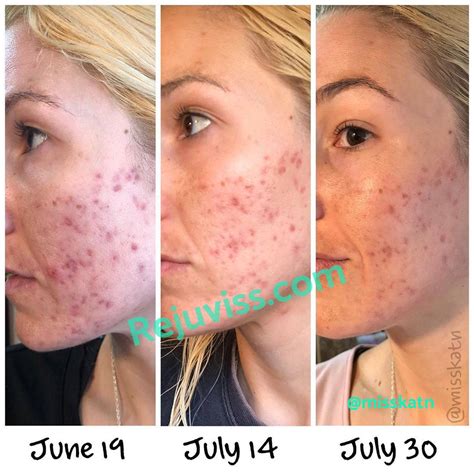 Dermaroller Before And After Pores - From the beginning, i varied the topical treatments i used ...