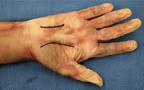 Figure 3 from Hand infections. | Semantic Scholar