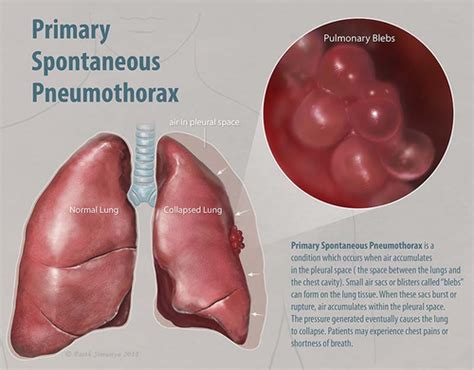 Pneumothorax Flashcards | Quizlet