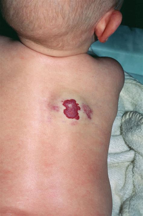 Strawberry Birthmark Photograph by Mike Devlin/science Photo Library