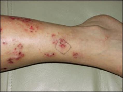 Morgellons Disease Pictures and Story | TimeSocket