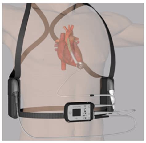 Left Ventricular Assist Devices in the Emergency Department - RCEMLearning