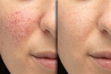 Acne or Rosacea: what's the difference?