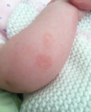 Red, nickel sized, circular rash on arm - ringworm, eczema or something else? | BabyCenter