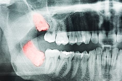 What is an Abscessed Wisdom Tooth? | NTFOS