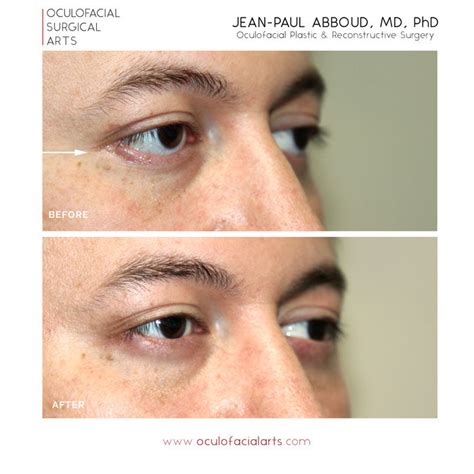 Almond Eye Procedure and Lower Eyelid Lift (Lateral Canthoplasty and Lower Retraction Repair)