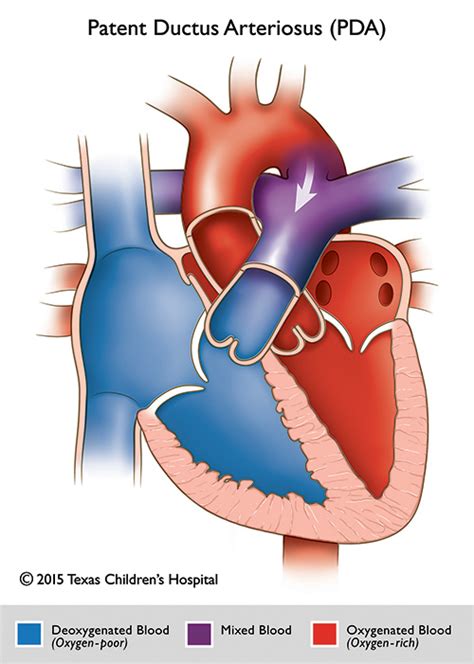 Patent Ductus Arteriosus Echo