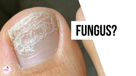 White Spots On Toenails Fungus