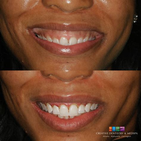 Atlanta GA Gummy Smile Correction | Sandy Springs Gum Reshaping/Contouring Near Me