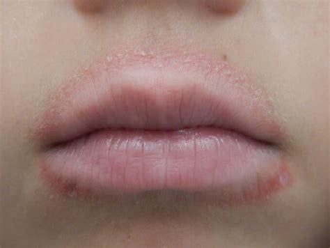 Dry Skin Above Upper Lip: Causes and Treatments - Skin Care Geeks