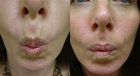 Botox treatment for crow's feet before and after photo