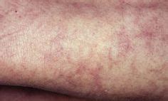 10 Mottled Skin ideas | livedo reticularis, skin, mottled