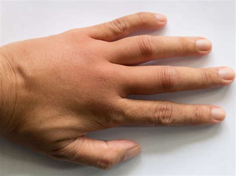 What Causes Your Fingers To Swell Up - ScienceHUB