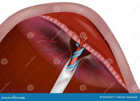 Placental Abruption, Placenta Separates from the Inner Wall of the Uterus before Delivery ...