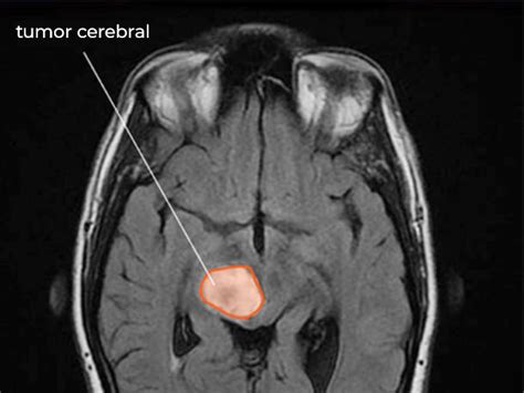 Análisis de sangre puede detectar cambios genéticos en tumores cerebrales