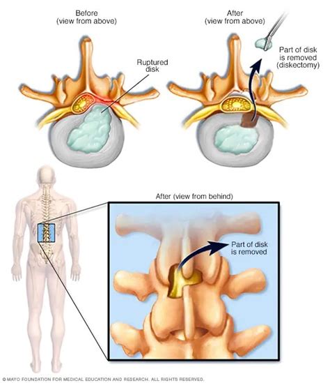 Herniated disk - Diagnosis and treatment - Mayo Clinic