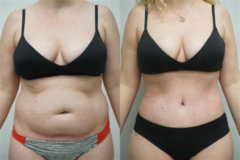 Tummy Tuck (Abdominoplasty) Before & After Photo Gallery | Gilbert, AZ | Dr. Josh Olson ...