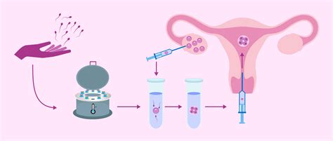 Process of IVF with donor sperm