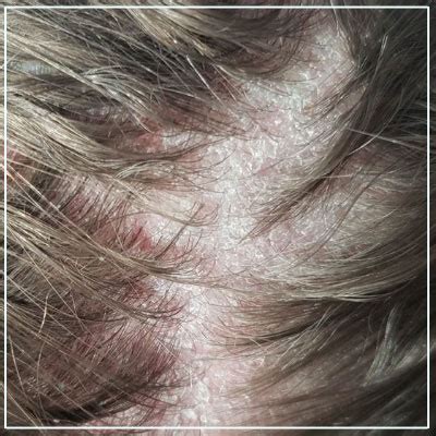 Seborrheic Dermatitis Scalp