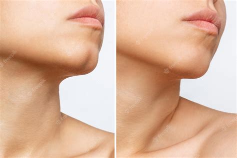 Chin Dimple Removal